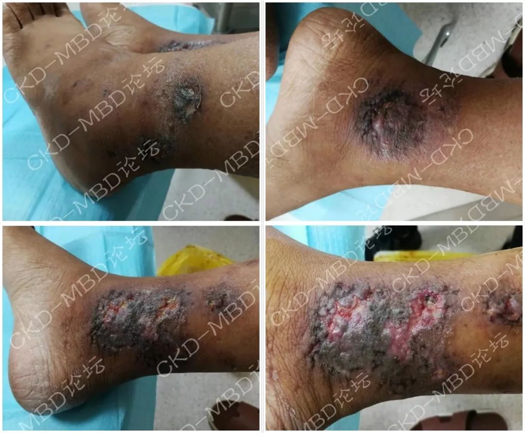 直击重点ckd钙化防御50问上