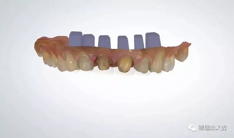 德瑞森数字化口扫