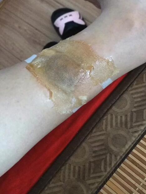 女子贴三伏贴皮肤灼痛起水泡医生起水泡才有效