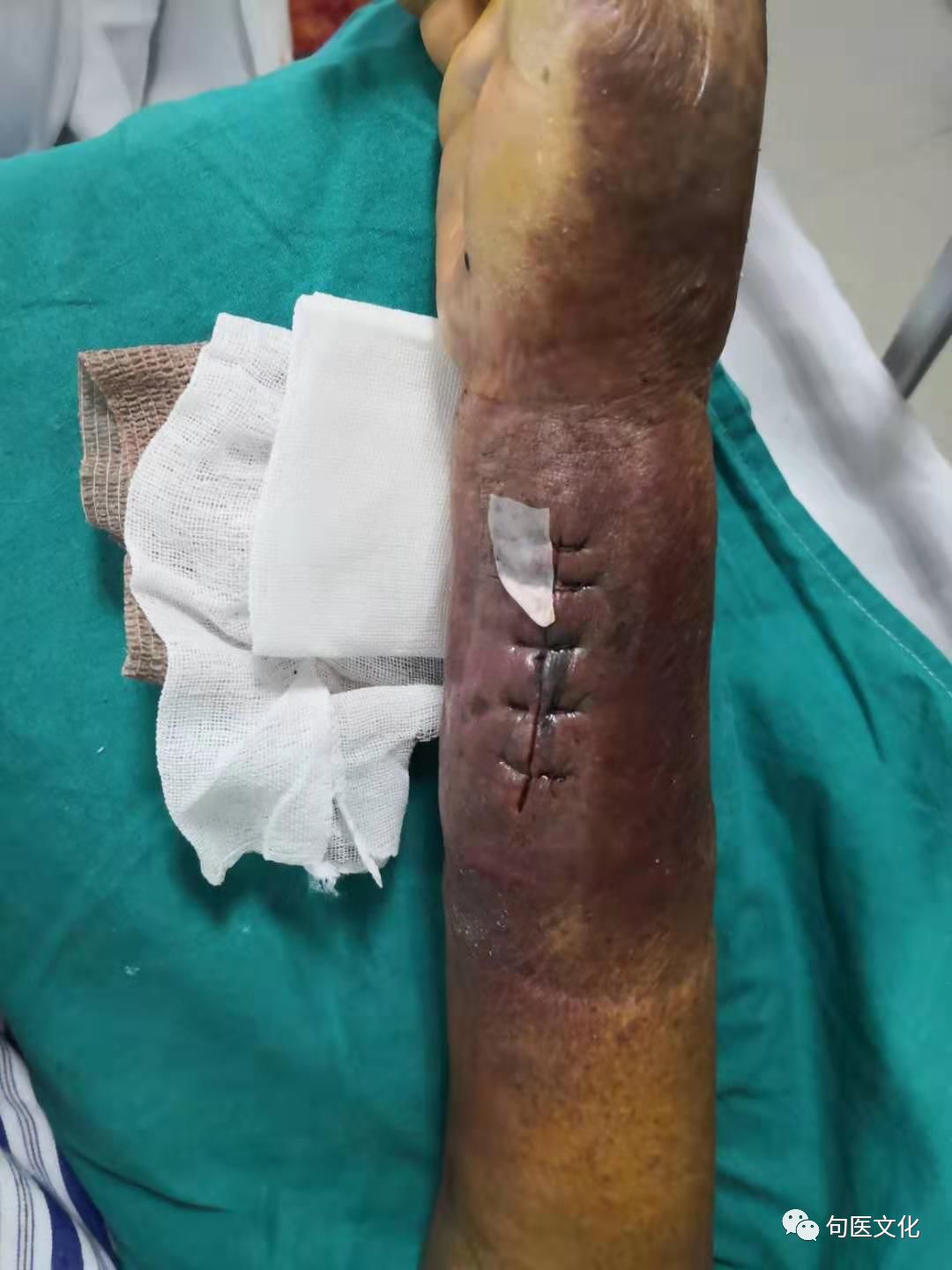 打造急危重症救治链系列报道二pci术后假性动脉瘤血管外科来帮忙