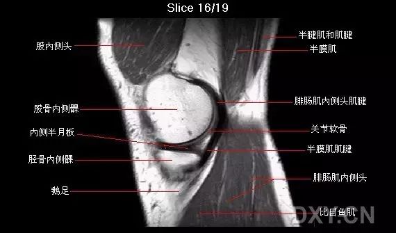 磁共振膝盖片子详解图图片