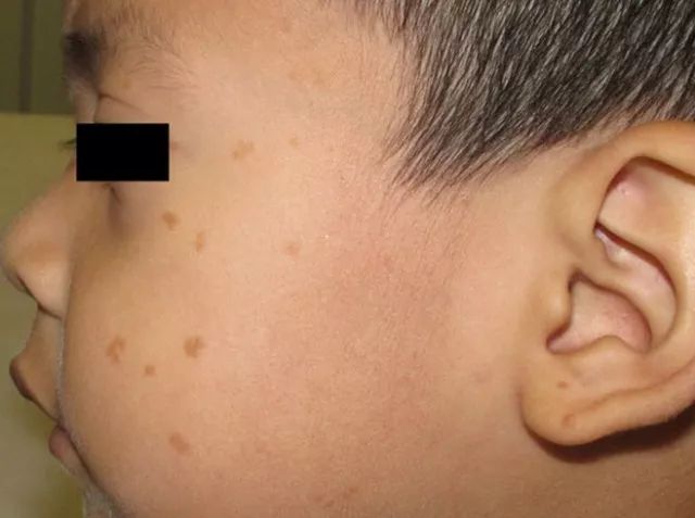 患儿为 2 岁男孩,因面部扁平丘疹 2 月就诊(图 1)