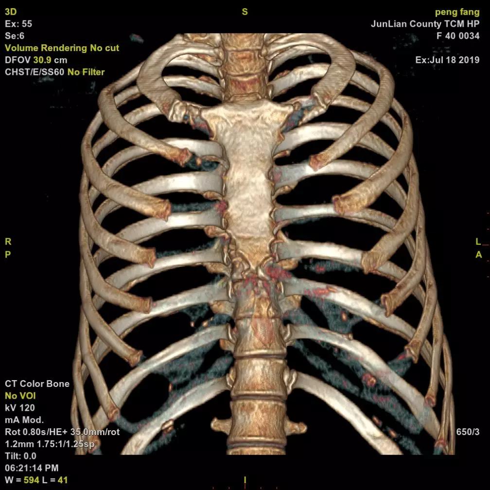 肋骨骨三维重建肋软骨三维重建内固定三维重建ctu新ct目前已正式投入