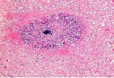 肾脓肿细胞图描述图片