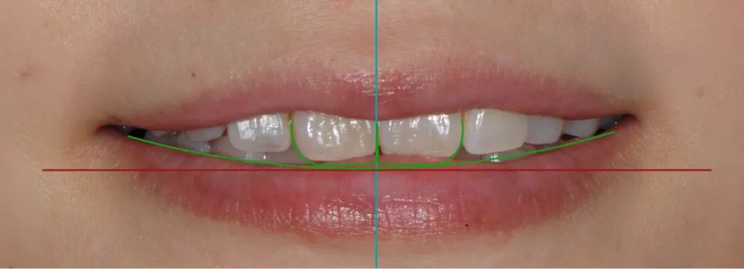 面像分析:瞳孔连线与切缘线平行中切牙中线与人中线稍偏a区1mm.