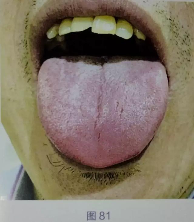 年轻人的剥苔比较容易恢复,该患者舌中凹陷比较明显(图84),素体脾胃不