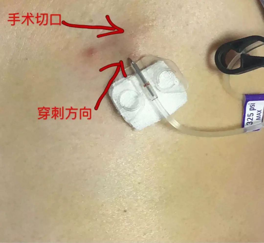 输液港蝶翼针:横着扎还是竖着扎?