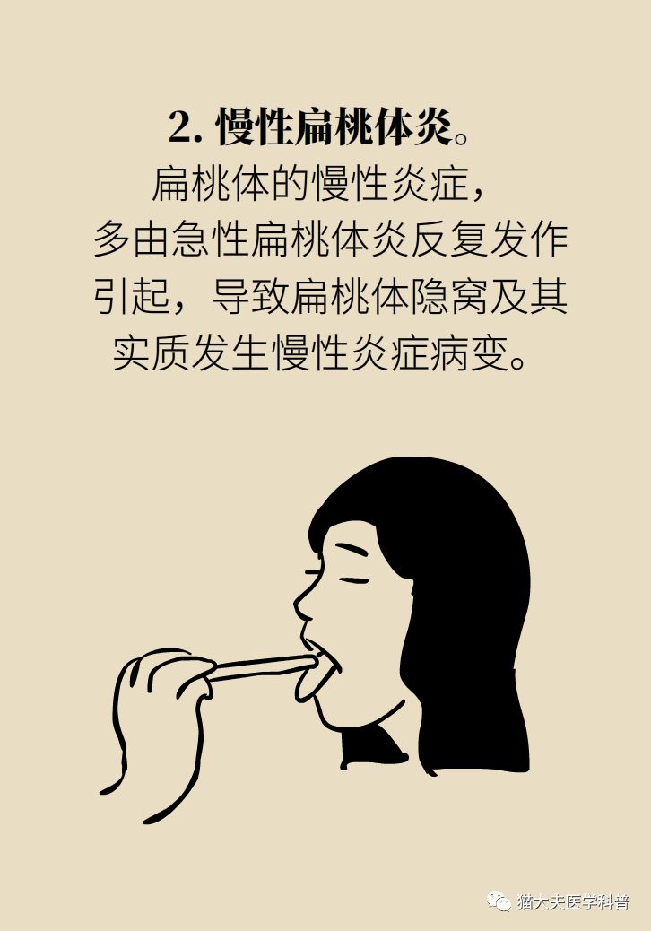 扁桃體反覆發炎,割不割?