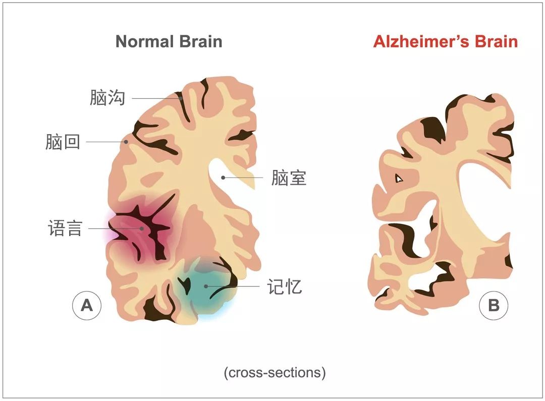 阿尔茨海默病(英文简称ad),是一种渐进性的大脑功能衰退性疾病,也称为