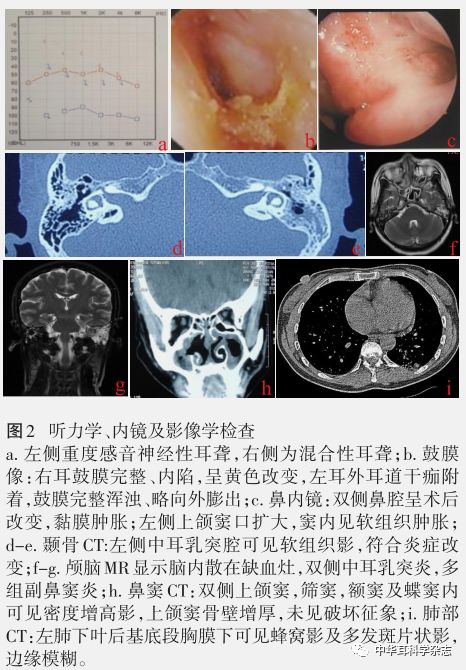 蝶窦 ct图片