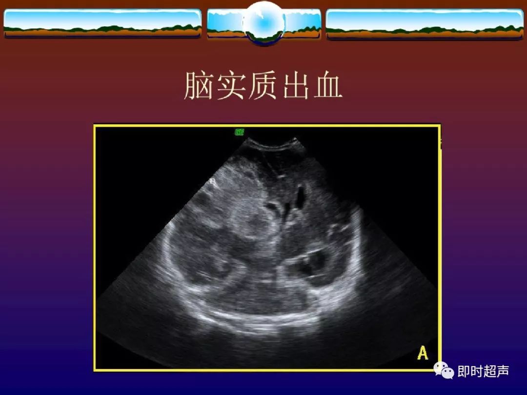 新生儿颅脑超声诊断