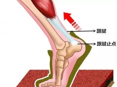 痉挛,就会导致其在跟骨止点处的慢性损伤引发疼痛,还有一点跟腱与跖