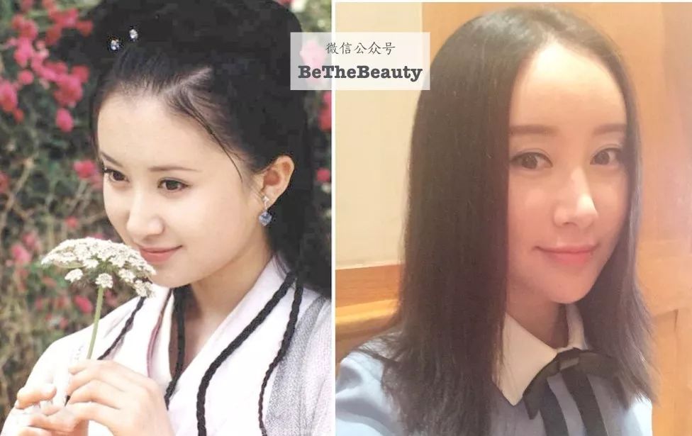 窄额头(所以要填充变高宽),大块颧骨(所以要内推),方腮靠下(因此要削