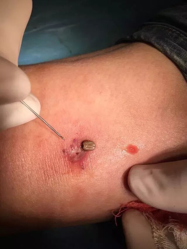 76发现停留在皮肤上的蜱虫时,切勿用力撕拉,以防撕伤组织或口器折断