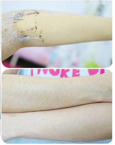 1分钟快速把毛脱干净,脱完皮肤光滑,毛发变细!_脱毛