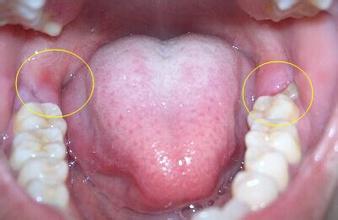 所以常常会因为空间不足而导致智齿萌生困难,引起疼痛,情况严重时,还