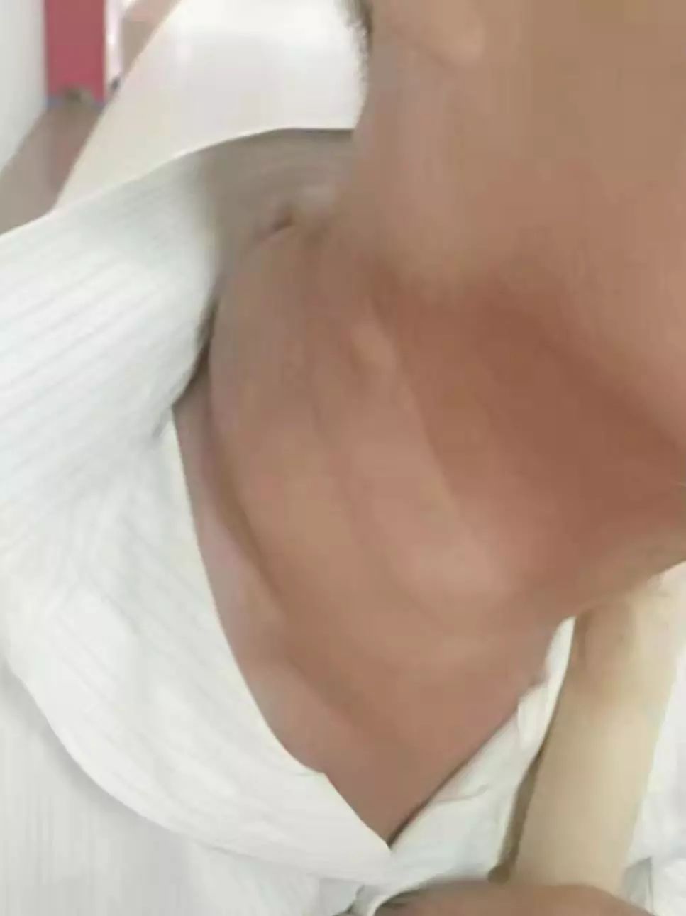 信宜一男子忽视自身颈部小硬包一照结果是淋巴瘤
