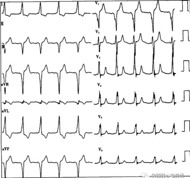 解析:该心电图显示v1导联delta波向下,qrs波群呈qs型,提示旁路位于右