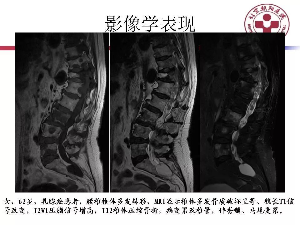 椎体转移瘤图片