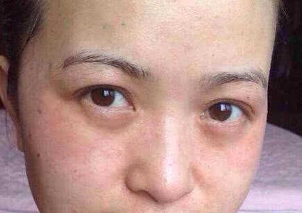 缺铁性贫血的人,多数有3个异常,做好3点,补血养颜