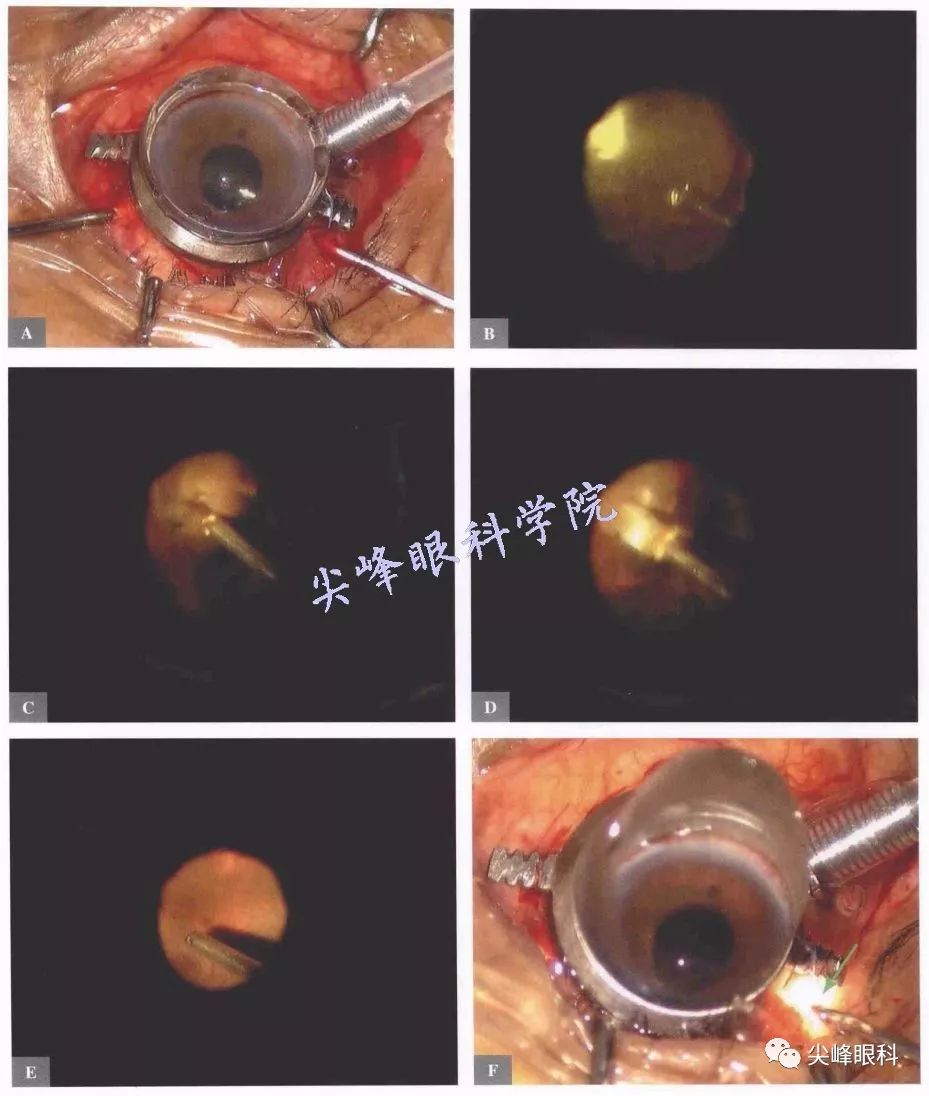 玻璃体视网膜手术中直视下睫状体光凝术图解青光眼手术操作与技巧063