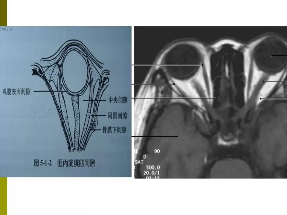 部分眼眶疾病的mri表现影像天地