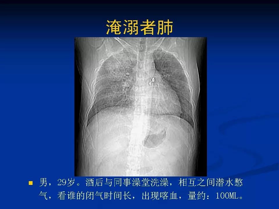 不同类型肺水肿的影像表现影像天地