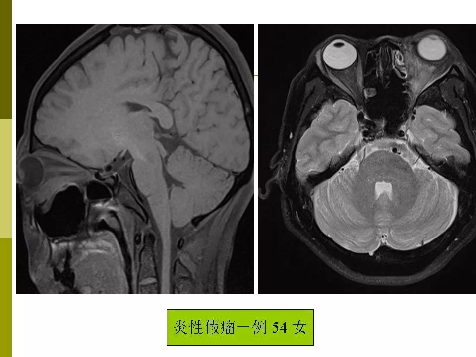 部分眼眶疾病的mri表现影像天地