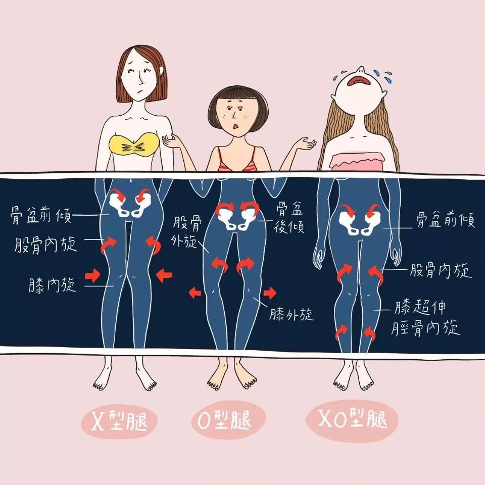 像是x型腿多半都是骨盆前倾的,而o型腿多半是骨盆后倾的.
