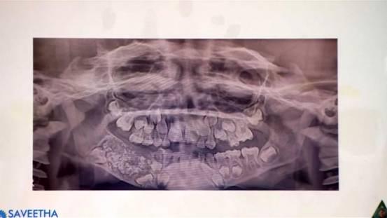 印度7岁男孩下颚肿胀 医生从他口中拔出526颗牙