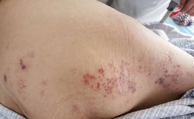 当骨质疏松性骨折遇到带状疱疹