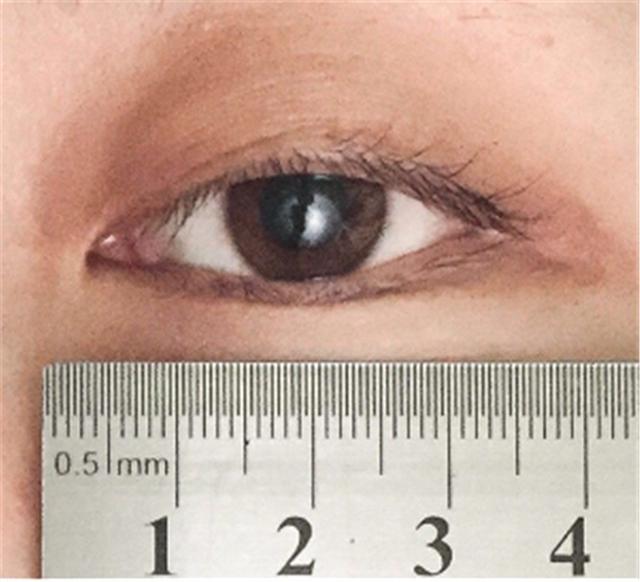 选择美瞳直径要考虑自己眼睛大小,以及瞳孔与眼白的比例