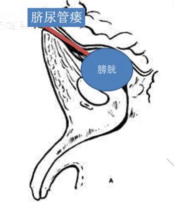 脐尿管囊肿手术步骤图片