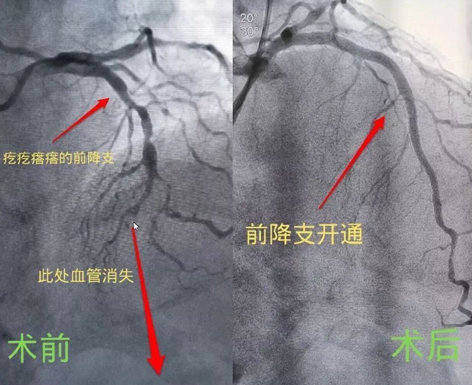 萬幸的是,導絲進入閉塞血管一試探,張健醫生團隊根據經驗判斷,這應該