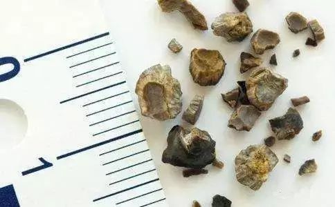 光喝水就能排出尿结石吗?