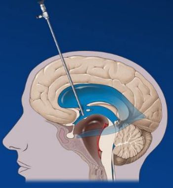 脑室底及术中所造瘘口△术前影像学表现神经外科一病区神经内镜组简介