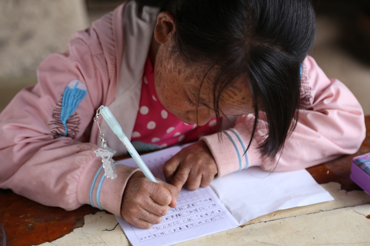 八岁女孩六旬容颜只因可恶的鱼鳞皮肤