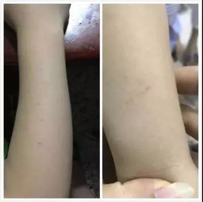 严惩!潮汕一幼儿园保育员竟针扎小朋友,手臂针孔触目惊心