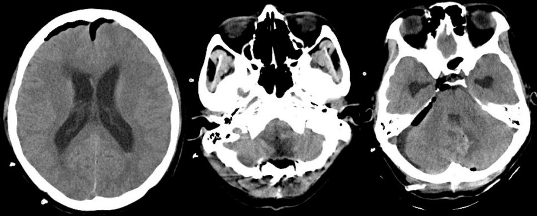 图1 术前mri:四脑室底肿瘤