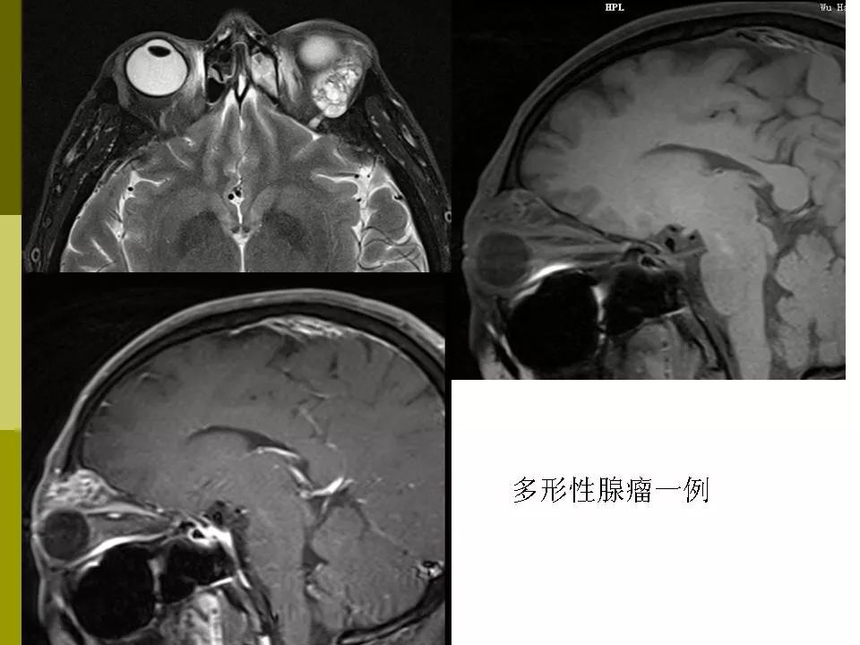 部分眼眶疾病的mri表现影像天地