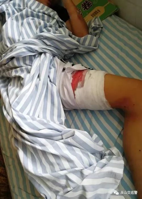【痛心】巫山14岁少年边玩手机边骑车,遇车祸致大腿伤口达30多公分