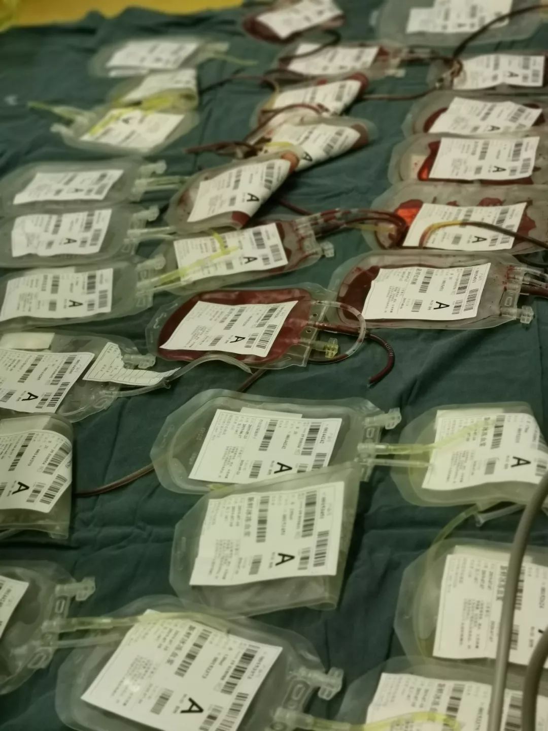 "我们发现产妇出血量较大,且血液不凝固,查了一下她的凝血谱呈现dic