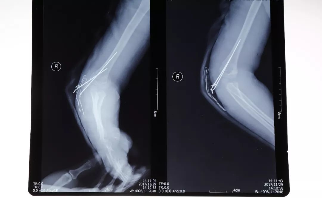 病例分享右肘內翻畸形