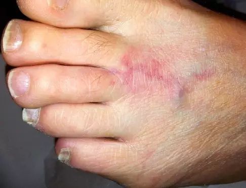 图 1 手指可触及的疼痛性红色结节在损害出现前数小时即出现局部疼痛