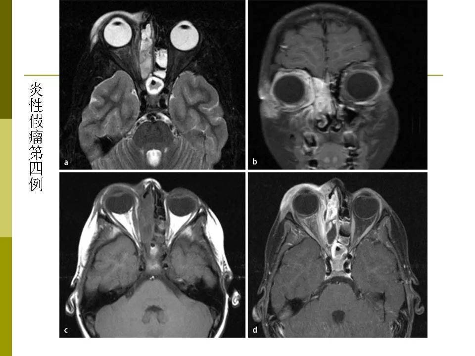 部分眼眶疾病的mri表現影像天地