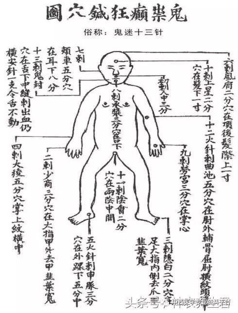 中医针灸精华鬼门十三针主治癫狂抑郁等精神类疾病