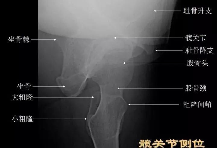 髋关节侧位图片图片