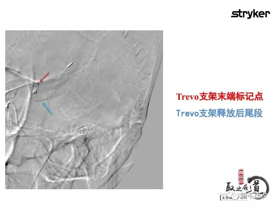 trevo支架在第一次释放结束后的造影,提示trevo取栓装置的前端导丝已