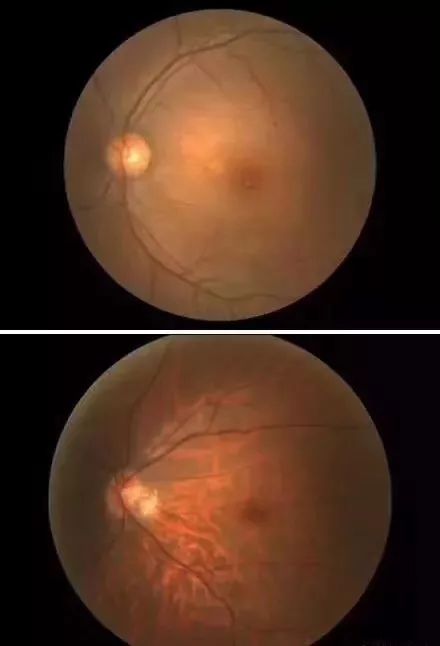 听说给孩子戴角膜塑形镜很麻烦的