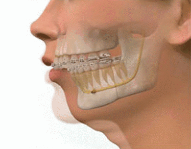 正颌手术动态图图片